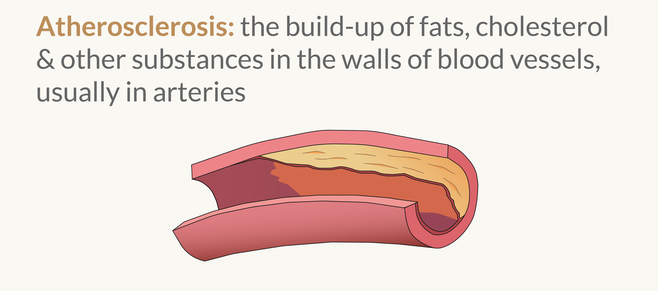 Illustration of Cardiovascular Diseases: Atherosclerosis and Aneurysm