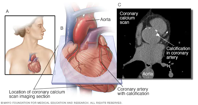 Coronary Artery Calcium Scan